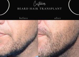 Beard Hair Transplant Before After Islamabad