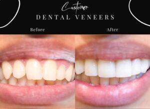 Dental Veneers before after results