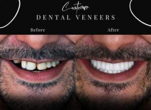 Dental Veneers in Islamabad