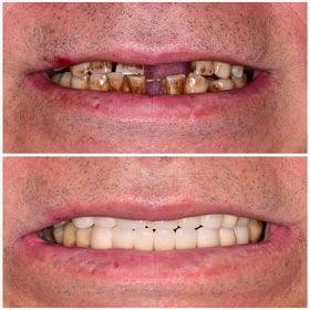 implant treatment before and after picture