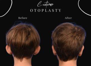 Ear reshaping before after results