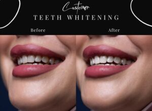 Teeth Whitening before after results