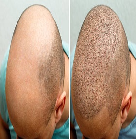 crown hair transplant cost in islamabad