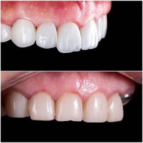 dental implant before after in islamabad