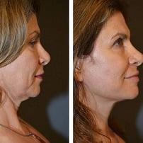 facelift treatment in islamabad