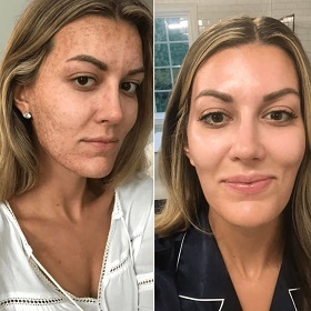 microneedling before after results