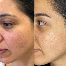 microneedling Cost in Islamabad