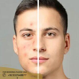 Acne Scar Treatment in islamabad