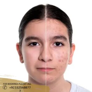 Acne scar treatment before after results