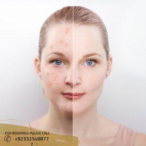 Acne scar treatment cost in islamabad