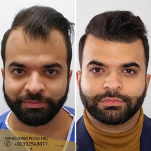 Before after results of Hair transplant