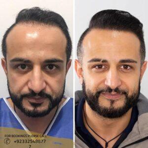 Hair transplant before after results