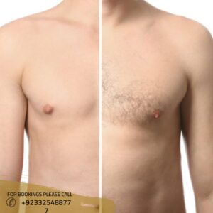 before after results of laser hair removal