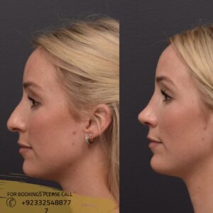 before after results of rhinoplasty ( nose surgery)