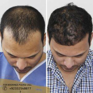 best surgeon for hair transplant in islamabad