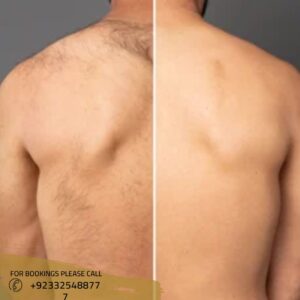 laser hair removal cost in islamabad