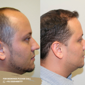 best surgeon for hair transplant in islamabad
