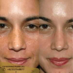 Chemical peel in Islamabad results