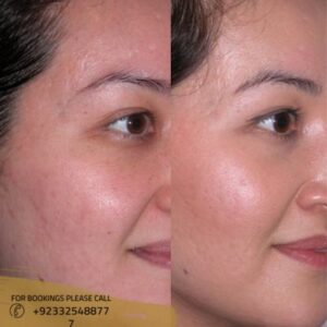 Microdermabrasion in Islamabad