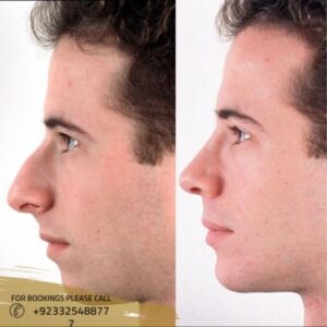 Non surgical nose job in islamabad, pakistan results