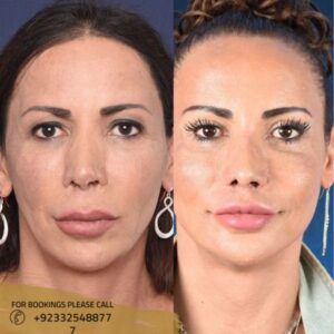 V-shape face treatment results