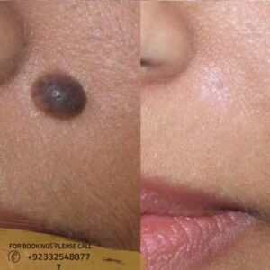 Warts removal in Islamabad