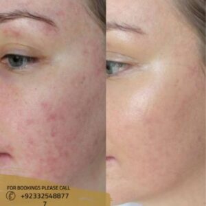 before after results of Microdermabrasion
