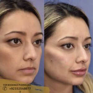 before after results of cheek augmentation - ERC