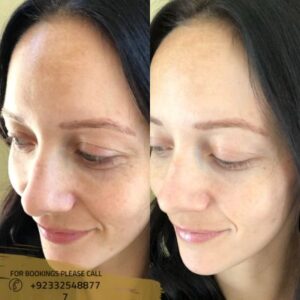 before after results of chemical peel treatment