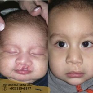 before after results of cleft lip and palate