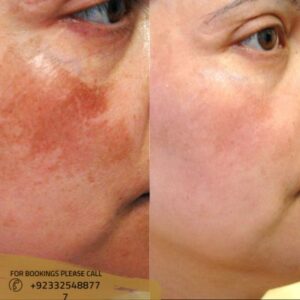 before after results of dermal pigmentation