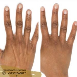 before after results of hand rejuvenation