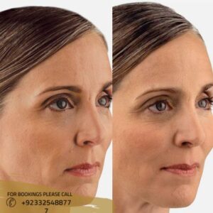 before after results of juvederm fillers in Islamabad