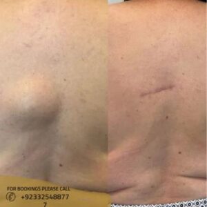 before after results of lipoma treatment