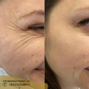 before after results of sculptra fillers