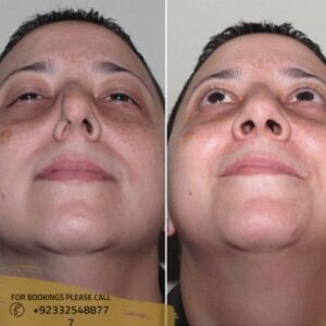 before after results of septoplasty