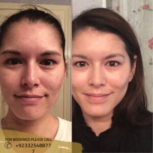 before after results of skin rejuvenation