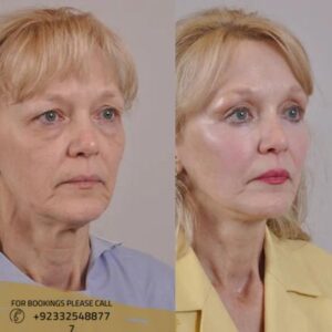 cheek augmentation before after results