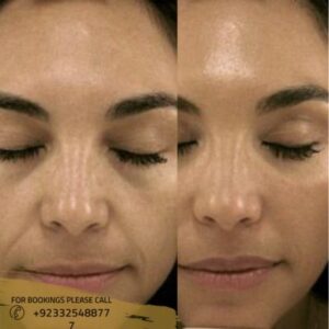 chemical peel before after results