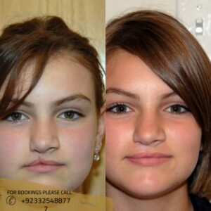 cleft lip and palate treatment before after results