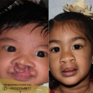 cleft lip and palate treatment in Islamabad, Pakistan - ERC