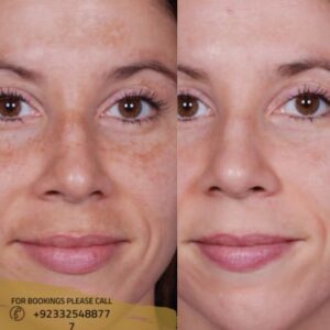 dermal pigmentation treatment results