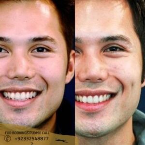 dimple creation before after results - ERC