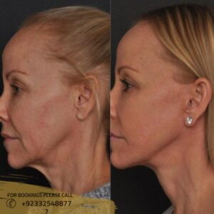 facelifts before after results - ERC