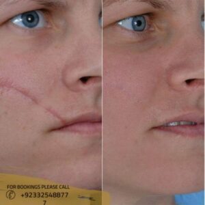 facial scar revision treatment - ERC