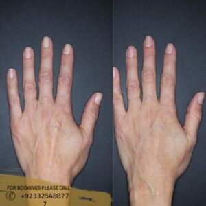 hand rejuvenation before after results