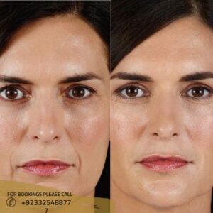 juvederm fillers in islamabad - ERC