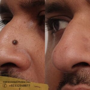 laser mole removal before after