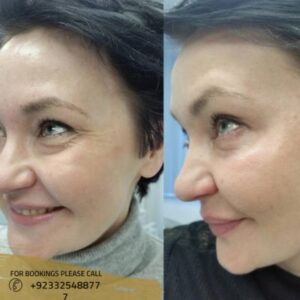 sculptra fillers in islamabad