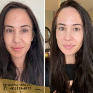skin rejuvenation treatment before after results